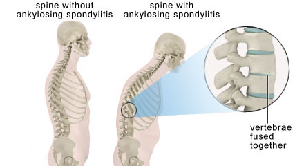 ankylosing spondylitis chiropractic